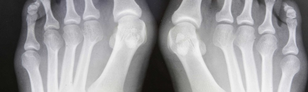 Grungy X-ray Of Feet With Bunions